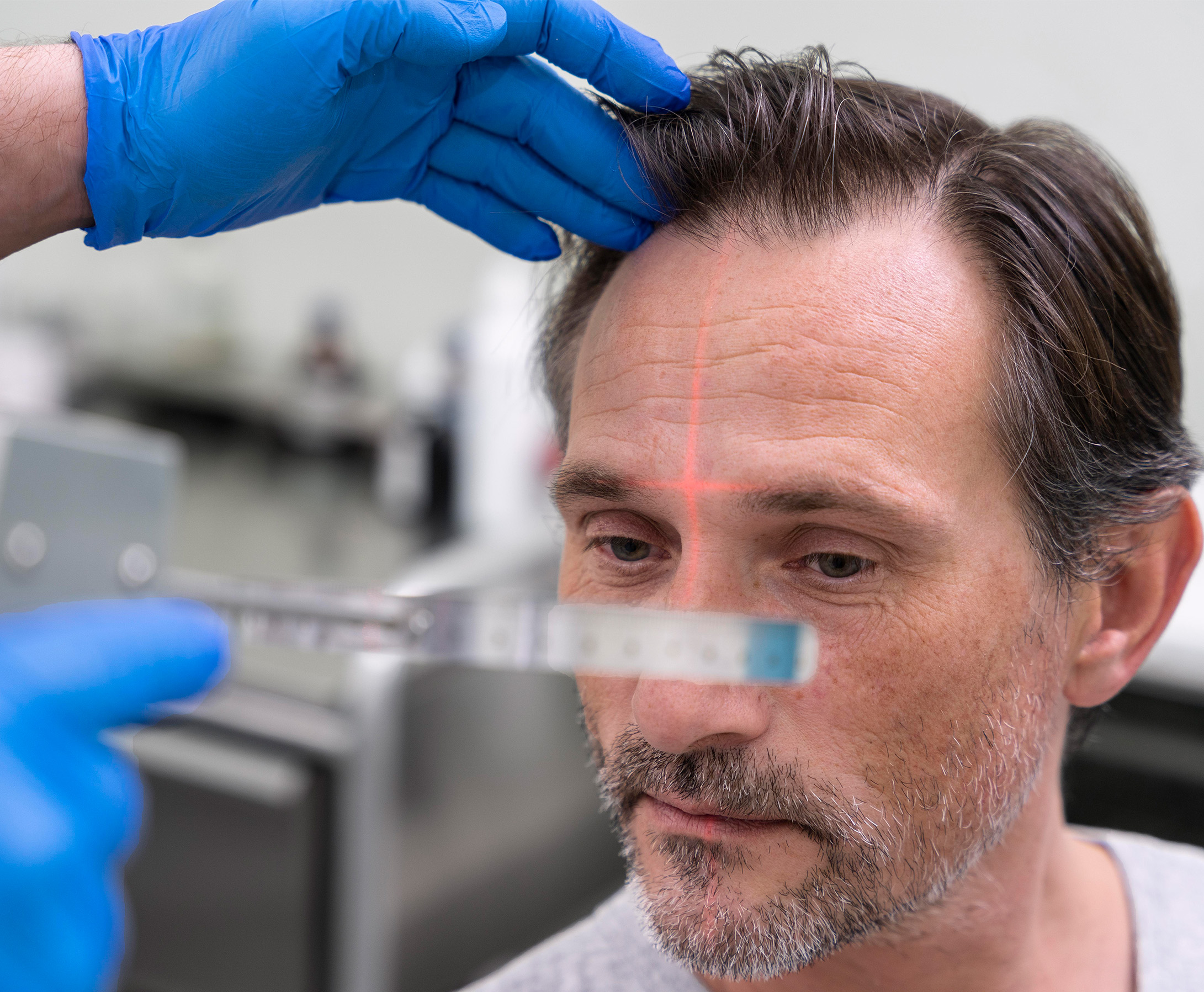 Follicle Fusion Hair Transplant