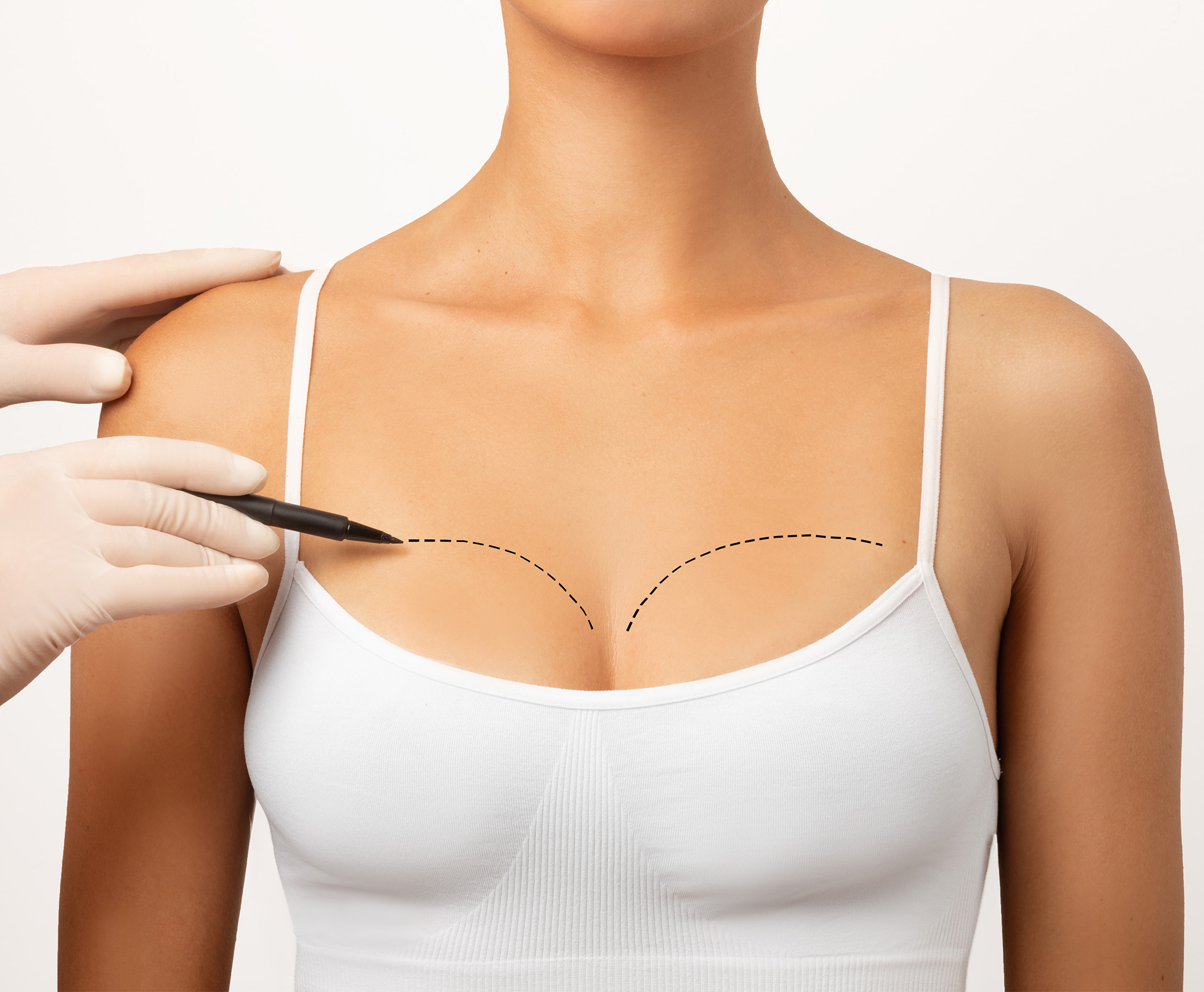 Breast Augmentation