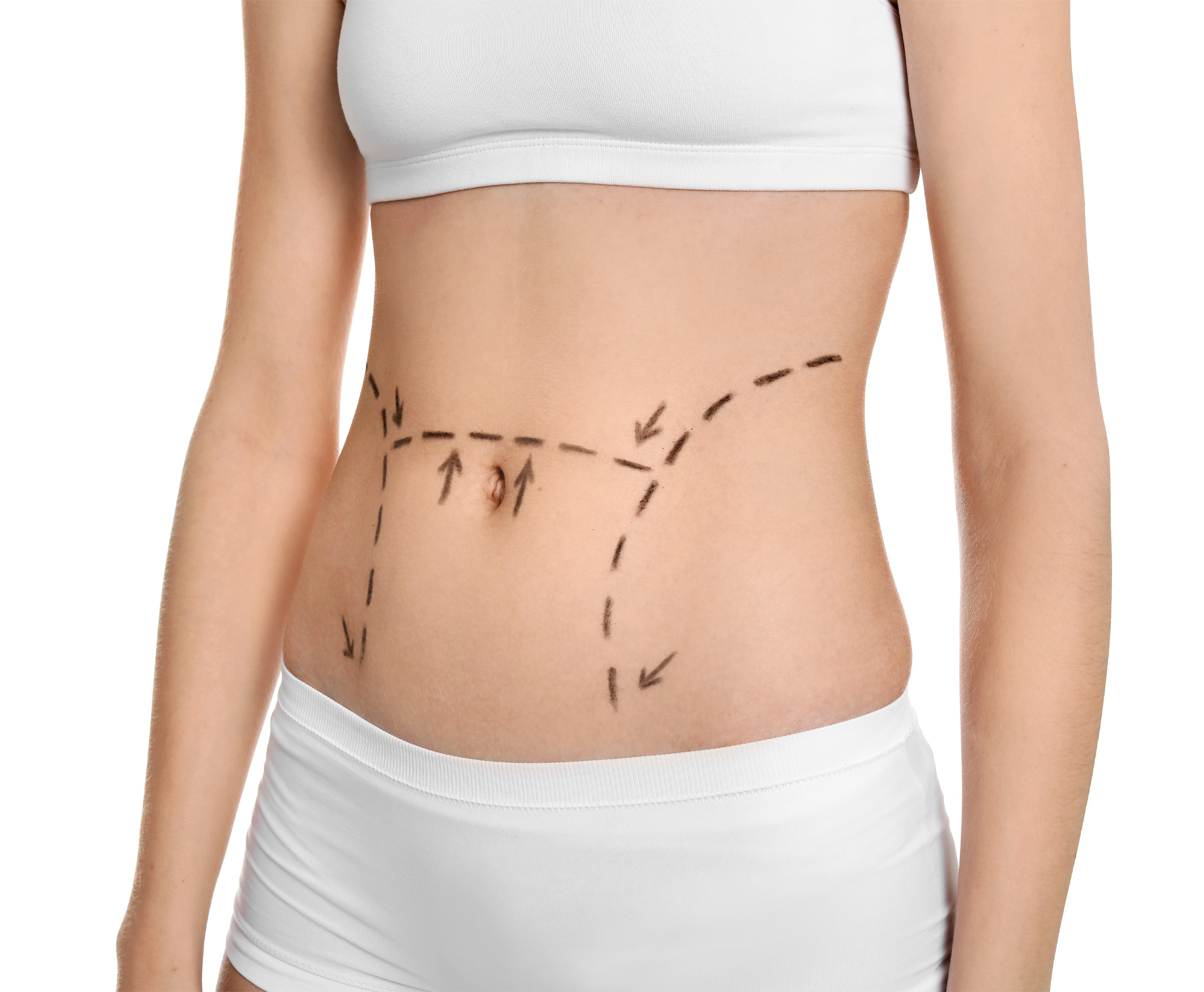 Tummy Tuck Treatment