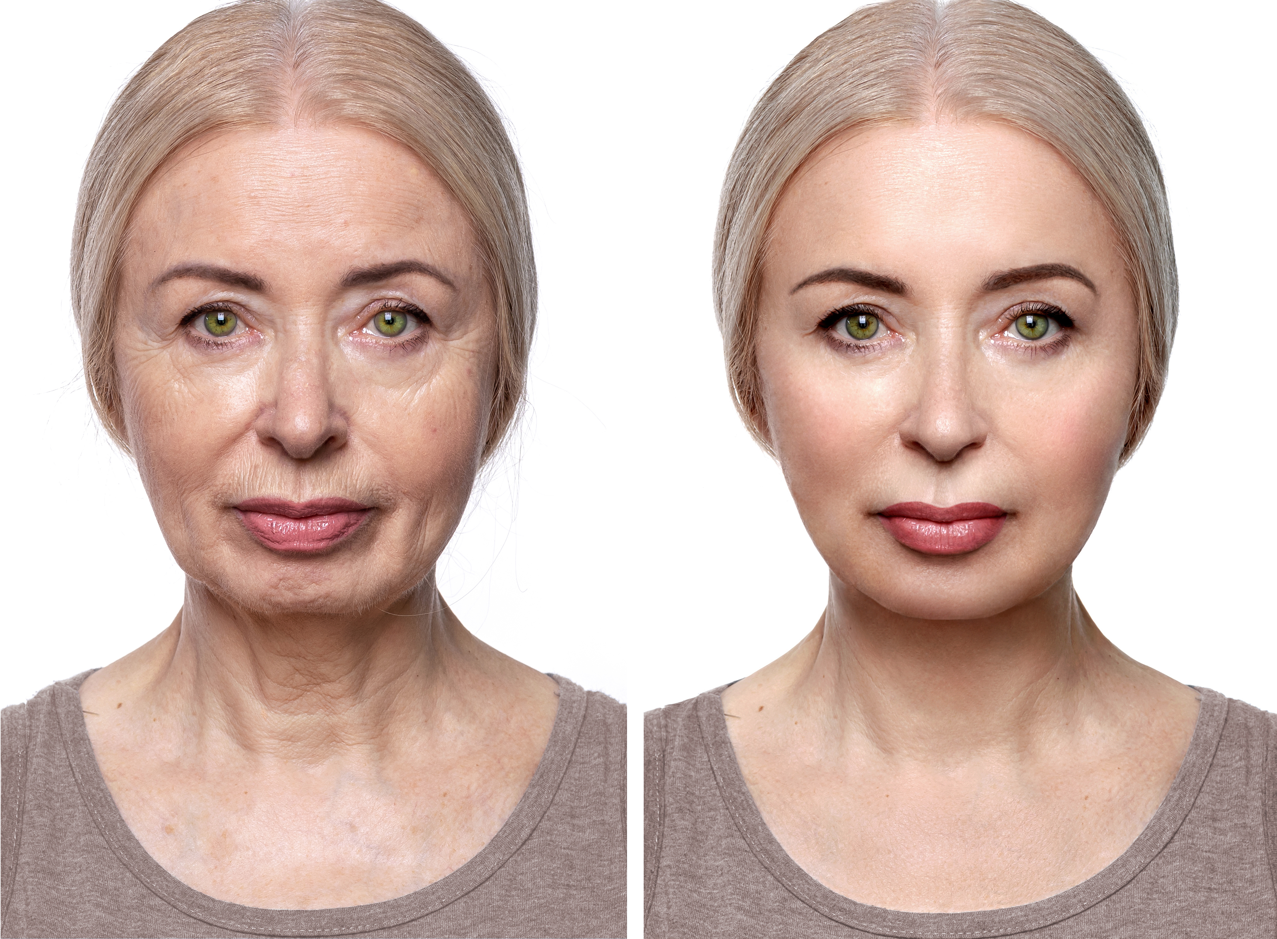 Iron Out Those Wrinkles: Rejuvenate Your Face with Autologous Fat Transfer