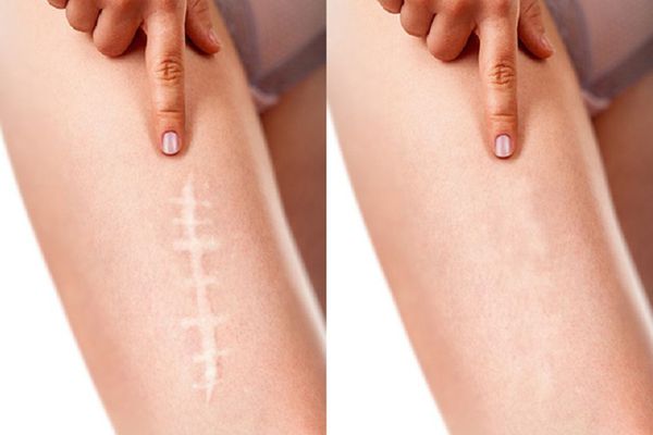 Can a Scar Really Ruin Your Big Day? Discover the Best Skin Treatments to Heal It