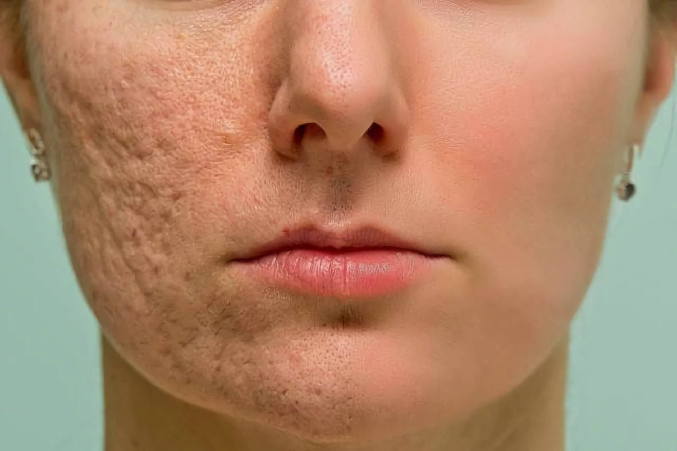 Are Laser Treatments the Right Solution for Your Skin & Hair Concerns?