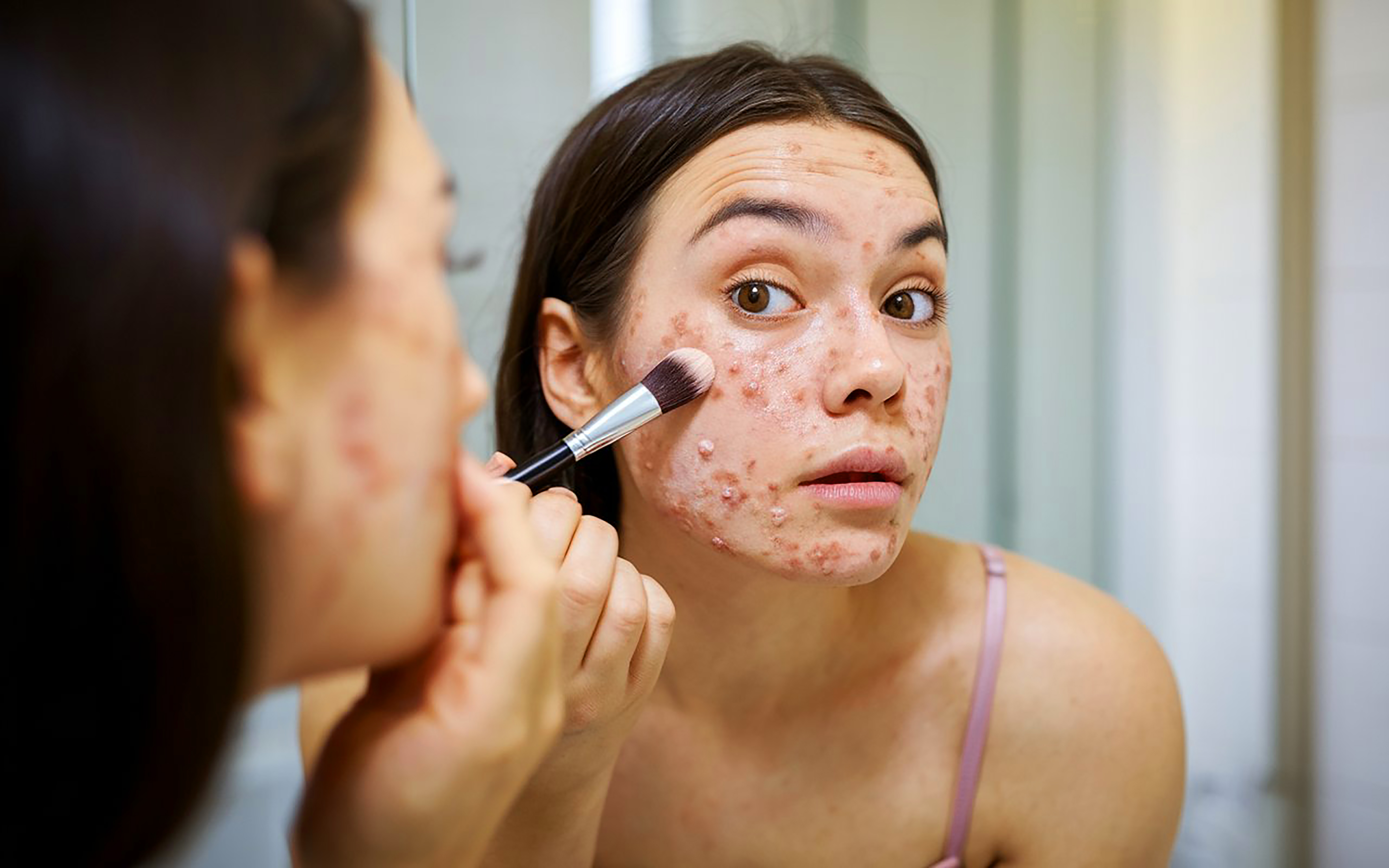 5 Makeup Mistakes That Worsen Your Acne