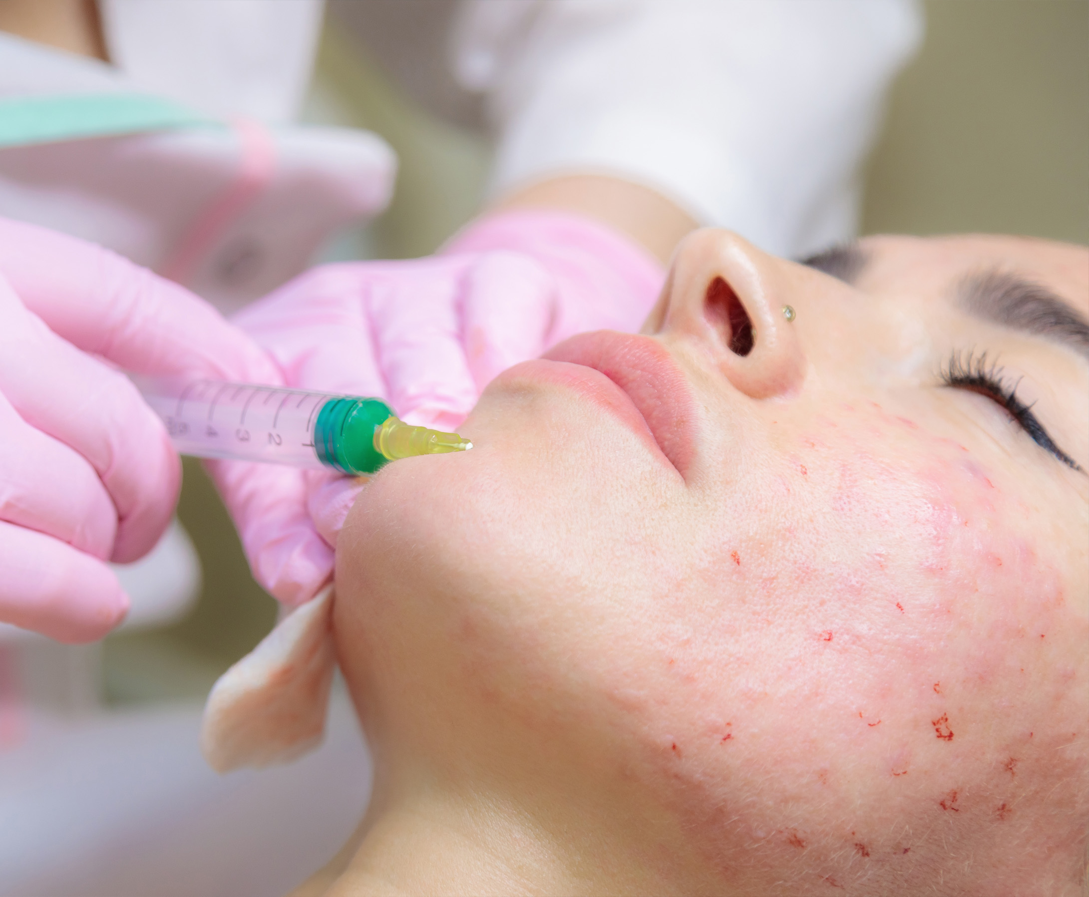 blemish-buster-acne-treatment